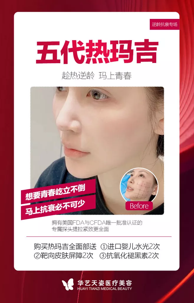 五代热玛吉医美文案