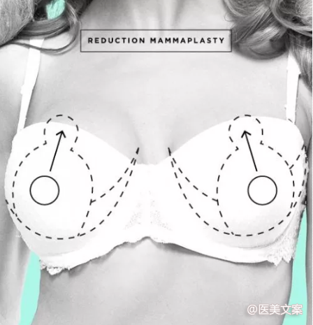 让文案更有魅力，隆胸篇，吸脂篇医美文案